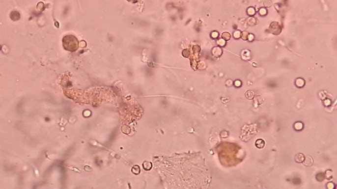 جیاوازی نێوان RBC & Pus cell